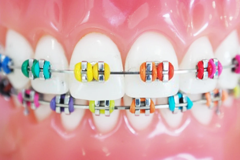 aparelho ortodontico colorido
